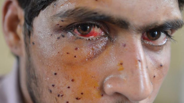 The despair of Kashmiri pellet victims